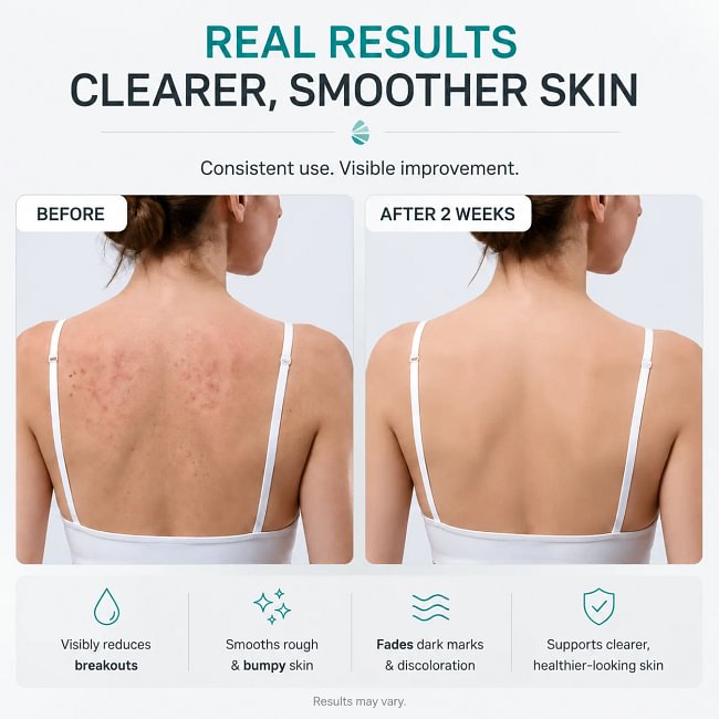 Level 2 Mandelic Acid Serum | Body Acne Treatment, Clear Butt Acne, Folliculitis, Fungal Acne, Hyperpigmentation, Ingrown Hairs | Daily Skincare, Safe for Sensitive Skin, Skin Repair, Fungus