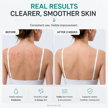 Level 2 Mandelic Acid Serum | Body Acne Treatment, Clear Butt Acne, Folliculitis, Fungal Acne, Hyperpigmentation, Ingrown Hairs | Daily Skincare, Safe for Sensitive Skin, Skin Repair, Fungus