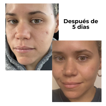 Dr.Leo 24H Acne & Pimple Treatment Drying Lotion | Salicylic Acid + Sulfur + Niacinamide | Viral Product | Inflammation Relief, Post-Blemish Care & High Pressure Pimple Relief