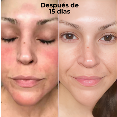 Dr.Leo 24H Acne & Pimple Treatment Drying Lotion | Salicylic Acid + Sulfur + Niacinamide | Viral Product | Inflammation Relief, Post-Blemish Care & High Pressure Pimple Relief