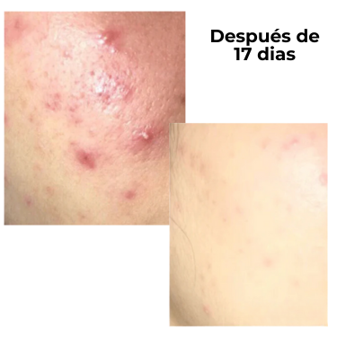 Dr.Leo 24H Acne & Pimple Treatment Drying Lotion | Salicylic Acid + Sulfur + Niacinamide | Viral Product | Inflammation Relief, Post-Blemish Care & High Pressure Pimple Relief